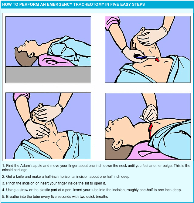 The Emergency Airway, Quick and Easy?